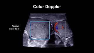 Diagnosing testicular torsion [upl. by Nauqal]