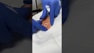 The Best Pimple Popper Video Ever This Cyst Exploded [upl. by Khudari]