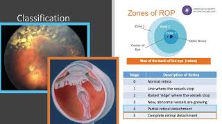 Retinopathy of Prematurity ROP [upl. by Merwyn]