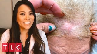 Removing a Boston Cherry Cyst  Dr Pimple Popper This is Zit [upl. by Grenville]