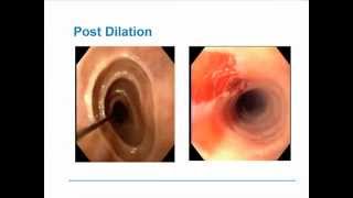 Eosinophilic Esophagitis [upl. by Columbyne764]