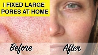 DIY LARGE PORES TREATMENT At Home Glycolic Acid Peel Dramatically Reduces Pores amp Wrinkles [upl. by Maroj]