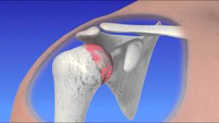 Shoulder Arthroscopy  Rotator Cuff Repair [upl. by Kacey]