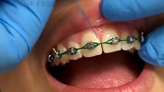 Flossing Braces With a Threader [upl. by Lepp]