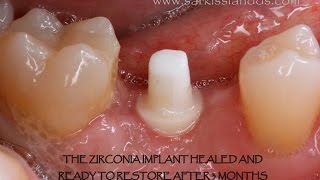 Zirconia Implant [upl. by Davena]