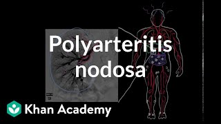 Temporal arteritis  Circulatory System and Disease  NCLEXRN  Khan Academy [upl. by Necyla441]