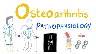 Osteoarthritis OA  Pathophysiology  Rheumatology Series [upl. by Inaluahek861]