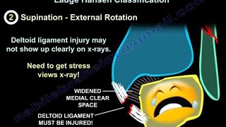 Treatment of Common Geriatric Fractures Spine and Pelvis [upl. by Shaia445]