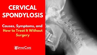 Removal of a Cervical Polyp [upl. by Nowaj276]