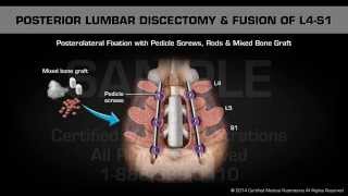 Discectomy vs Laminotomy by Dr Tony Mork [upl. by Eecart622]