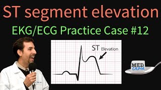 ST Elevation  EKG  ECG Interpretation Case 12 STEMI MI ACS [upl. by Ring]