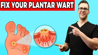 Plantar Warts Removal at Home Treatment Foot amp Toe Wart Remedies [upl. by Naloj]