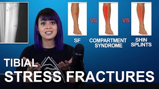 Tibial Stress Fractures Cause Treatment Comparisons [upl. by Nairda]