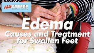 5 Ways to Get Rid of Edema [upl. by Marie533]