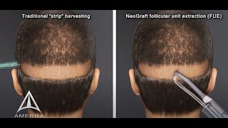 NeoGraft hair transplant procedure  animation [upl. by Lalo]