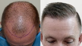 Hair transplant results after 1 year [upl. by Alaehcim534]