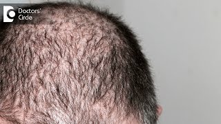 Minoxidil for hair loss  Dr K Prapanna Arya [upl. by Lehcim553]