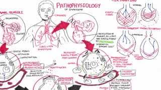 Emphysema  Pathophysiology COPD [upl. by Kcim]