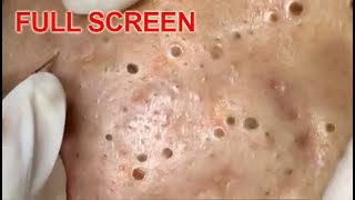 LARGE Blackheads Removal  Best Pimple Popping Videos [upl. by Aenej]