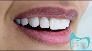 Naturallooking zirconia veneers [upl. by Lahcear]