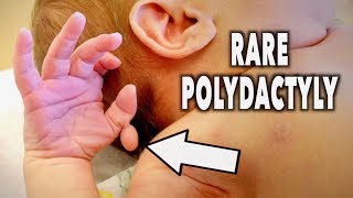 RARE POLYDACTYLY newborn  Dr Paul [upl. by Ahsiekim]