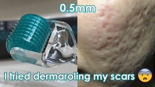 I tried dermarolling my ACNE SCARS  Demo  Review [upl. by Brigida]