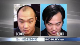 FUE Hair Transplant Timeline I Day 1 to Day 365 [upl. by Nancy]