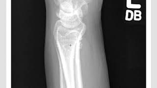 Distal Radius Fractures ER management Reduction and Tips [upl. by Wagstaff]