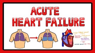 Acute Heart Failure  Types of Acute Heart Failure  Causes  Signs and Symptoms [upl. by Nnelg291]