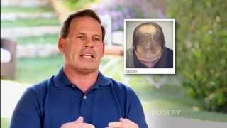 Bosley Hair Transplant Surgery Review  Adam K [upl. by Yraeht]