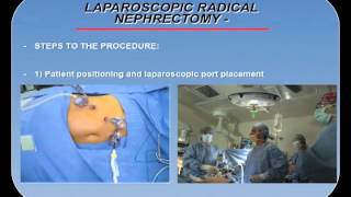 BASIC SET UP LAP CHOLECYSTECTOMY [upl. by Sung]