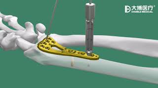 Double Medical Distal Radius Locking Plate variable angle [upl. by Yasmeen964]