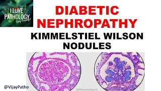 DIABETIC NEPHROPATHY Pathophysiology amp Morphology [upl. by Eniagrom621]