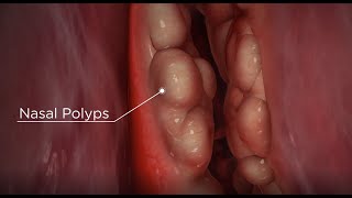 Nasal Polyps diagnosis and treatment options [upl. by Orual]