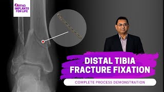 Distal Tibia Fracture  Distal Tibia Medial Locking Plate [upl. by Everrs932]