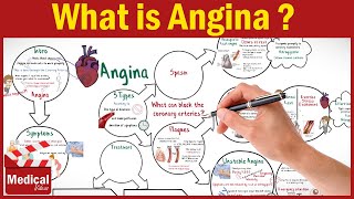 Pharmacology CVS 16 What is Angina Pectoris  Types of Angina Symptoms Causes and Treatment [upl. by Burack]