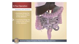 ColostomyIleostomy Your Operation [upl. by Poppo]