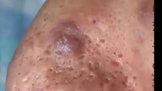 Pimples Popping On Nose Part 1 [upl. by Hart386]