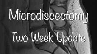 Anterior Cervical Discectomy and Fusion [upl. by Gage114]