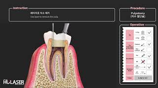 4 Pulpotomy 치수 절단술 [upl. by Stevie]