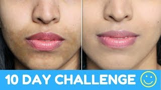 How To Get Even Skin Tone Naturally Powerful Home Remedy Hyper Pigmentation [upl. by Refinaj]