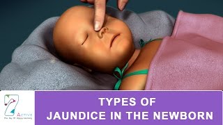 Jaundice Causes and Treatment  Dr Amit Sanghi Hindi [upl. by Hamlin]