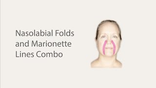 Face Taping for Nasolabial Folds and Marionette Lines [upl. by Picardi]