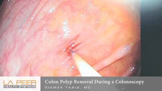 Colon Polyp Removal During Colonoscopy  Los Angeles La Peer Surgery Center [upl. by Kean572]