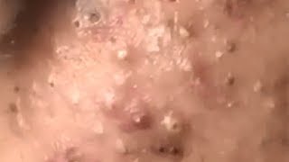 Huge Acne Pimples Blackheads Popping Up Satisfying with Oddly Calm Music [upl. by Llenhoj]