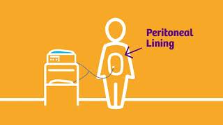 Peritoneal Dialysis Process [upl. by Galateah]