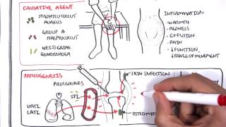 Septic Arthritis  Overview causes pathophysiology treatment [upl. by Donnelly]