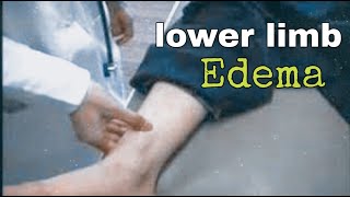 lower limb edema examination [upl. by Mariska]