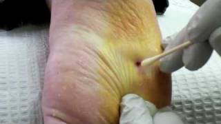 Surgical Plantar Wart Removal [upl. by Gillead262]