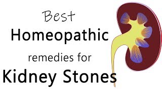 Best homeopathic medicine for stone in kidney  Dr Sanjay Panicker [upl. by Nauwtna]